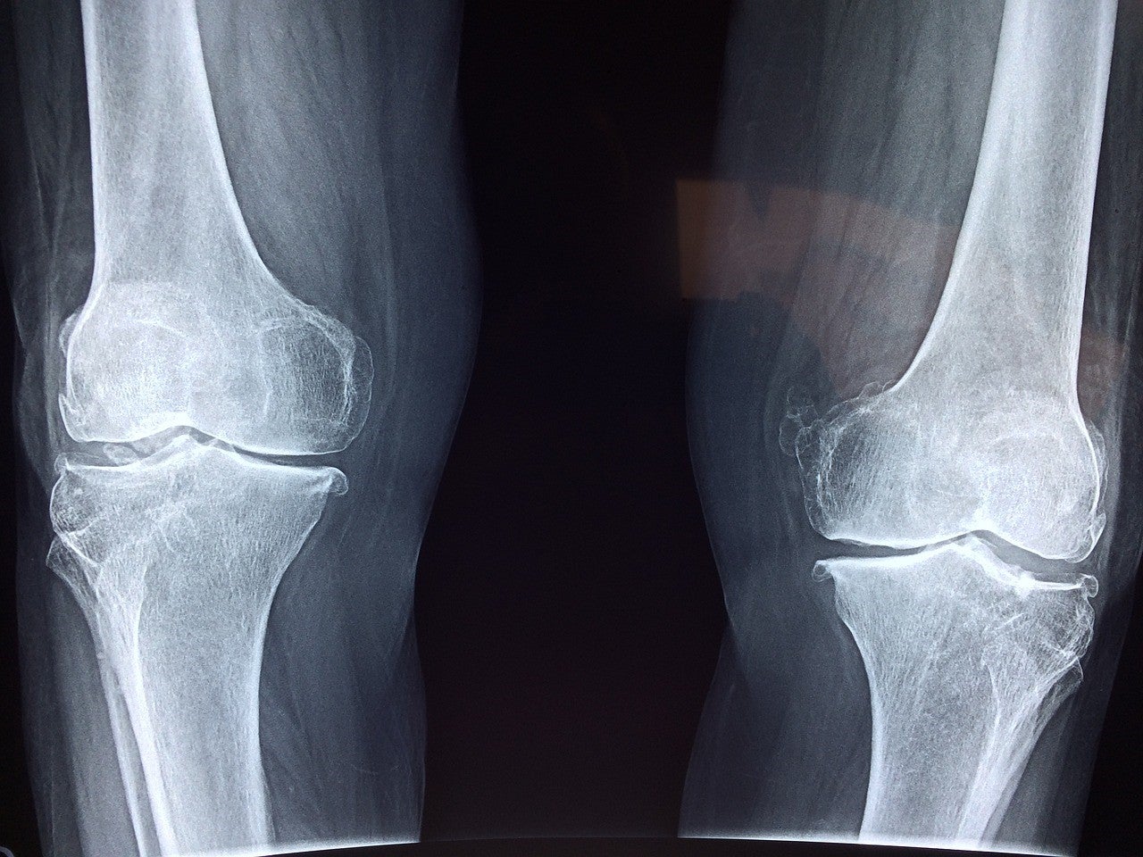 Unlocking the Secrets of Skeletal Cell Aging: New Insights Unveiled