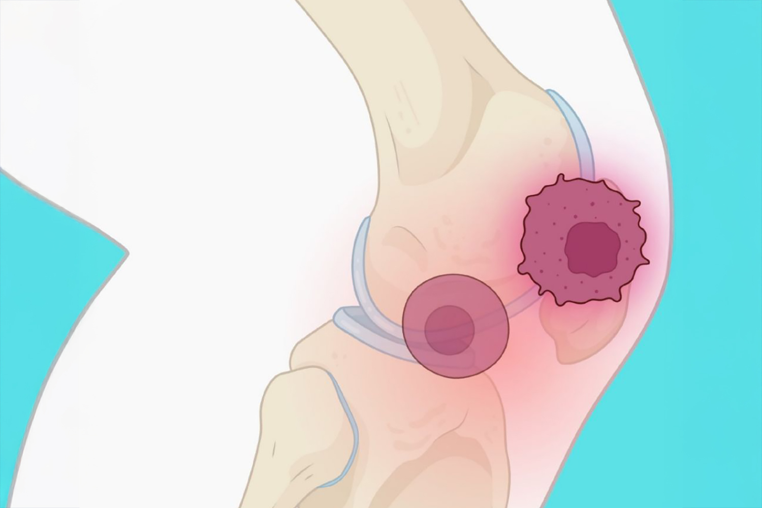 Revolutionary MRI Uncovers ‘Zombie Cells’ Linked to Arthritis Progression