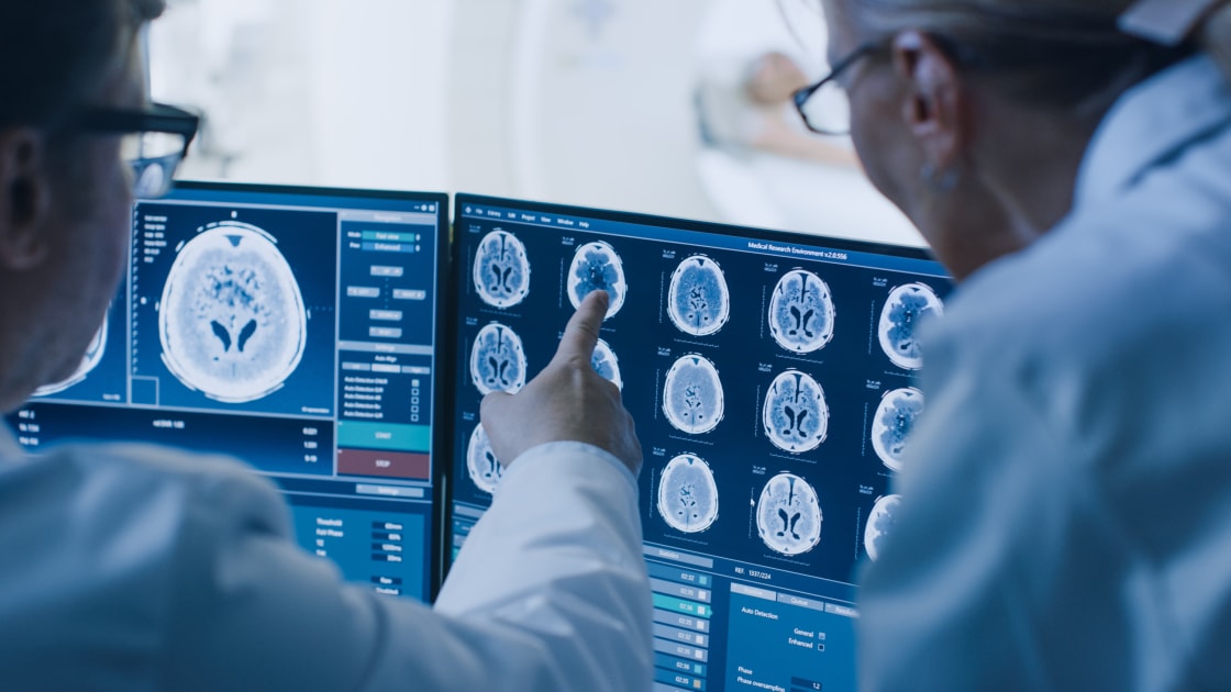 New Discoveries Uncover Vital Insights into Glioblastoma Recurrence