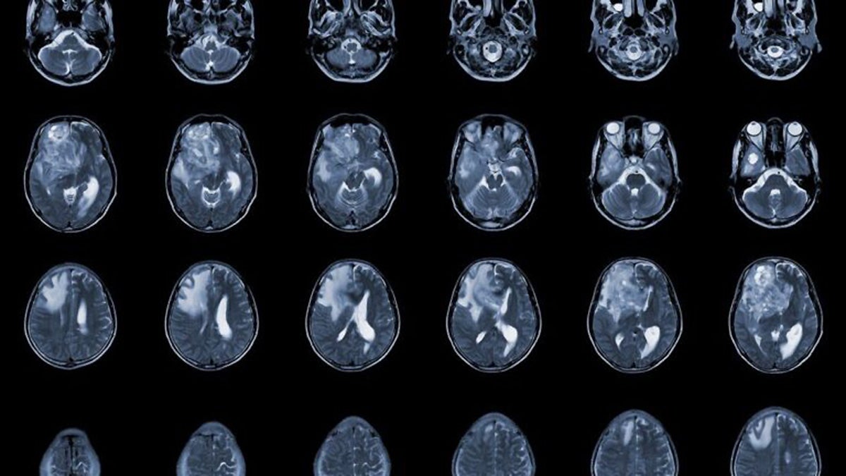Innovative Compound Disrupts Circadian Rhythms to Combat Glioblastoma Cells