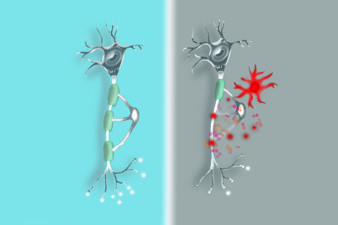 New Insights Connect CAR-T Cell Cancer Treatment to Cognitive Challenges