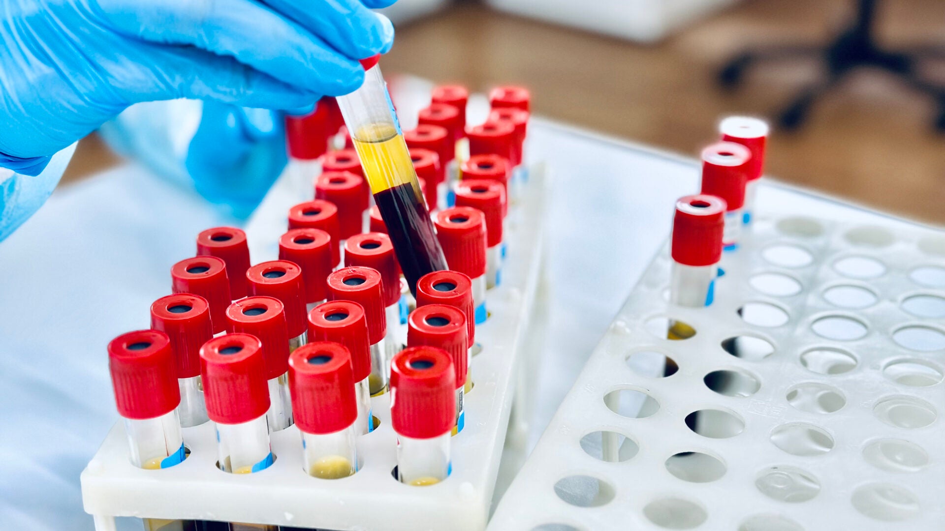 Affordable Blood Test Pioneered by USC Researchers for Early Alzheimer’s Diagnosis
