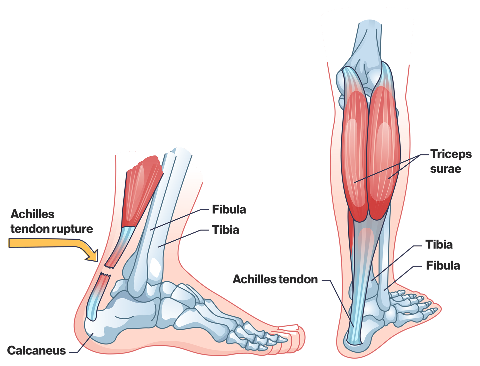 Diagram illustrating the location of the achilles tendon.