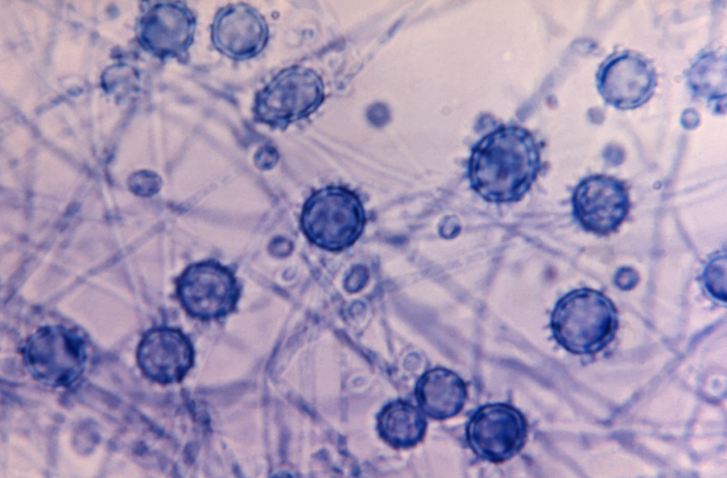 WashU Medicine Fungal Experts Tackle Commonly Misidentified Infections