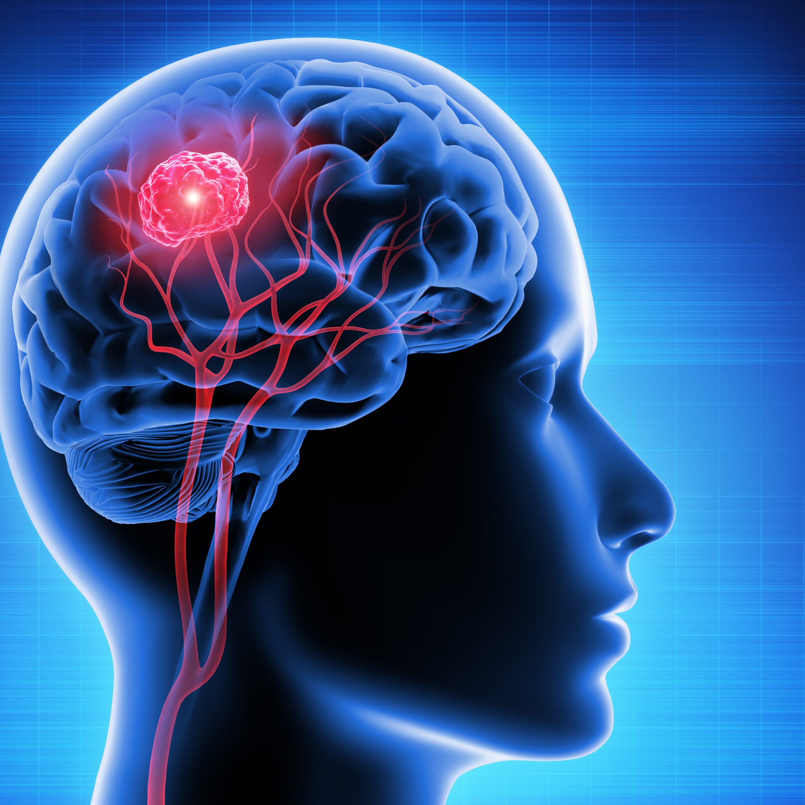 Revolutionary Yale-Mayo Clinic Collaboration Discovers Genetic Pathway in Brain Cancer Research