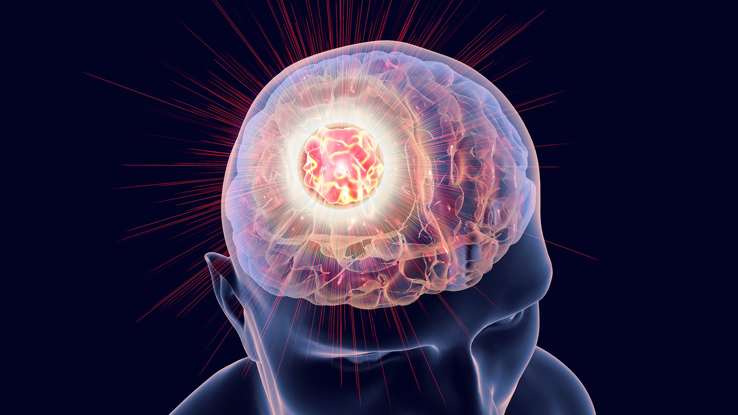 could-electric-fields-supercharge-immune-attack-on-the-deadliest-form-of-brain-cancer?