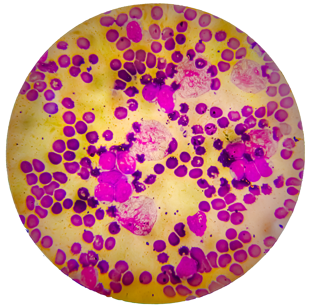 Harnessing the Potential of CAR-T Therapy