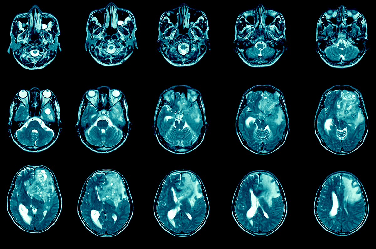Harnessing the Potential of CAR-T Therapy