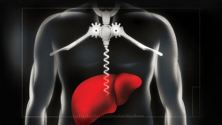 USC physicians are addressing a post-COVID increase in alcohol-related hepatic disease. (Illustration/Brian Stauffer)