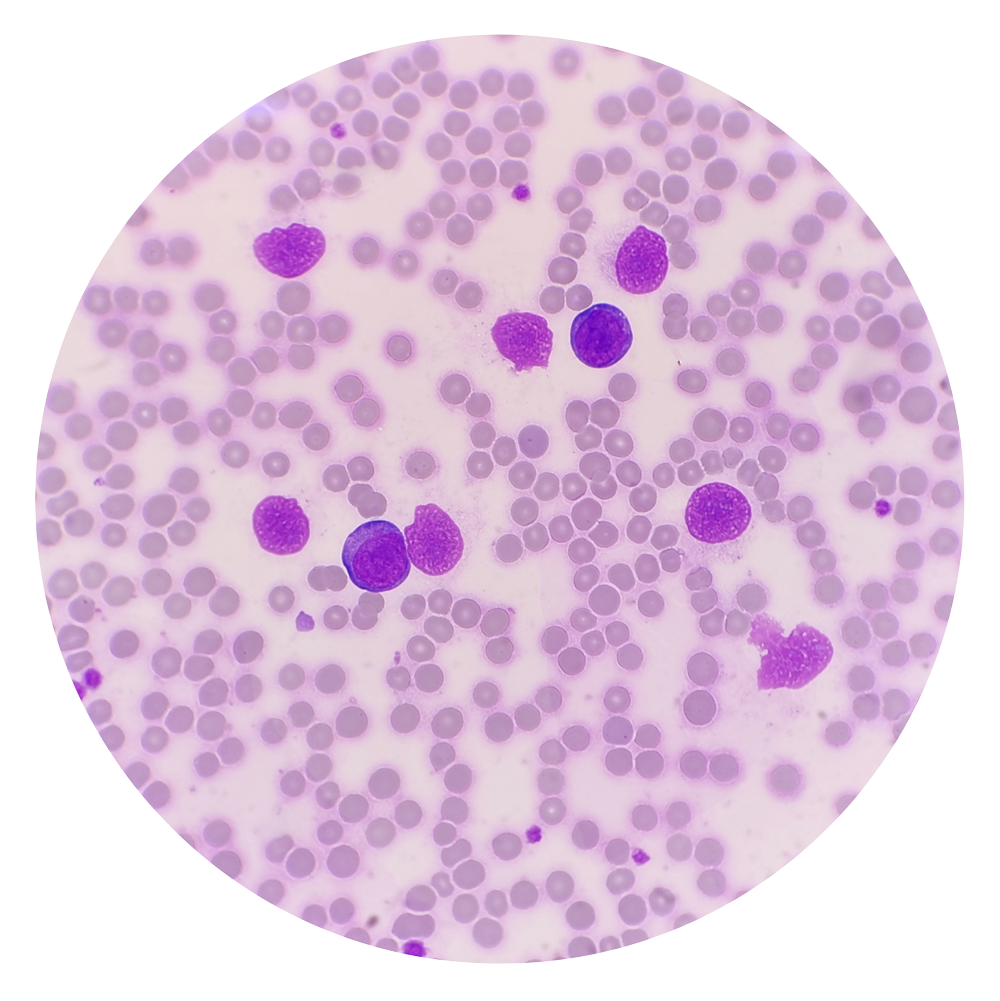 Harnessing the Potential of CAR-T Therapy