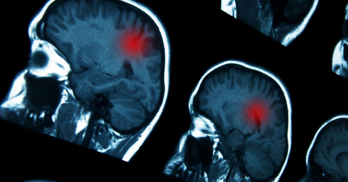 Markey researchers identify genetic marker that could guide brain cancer treatment