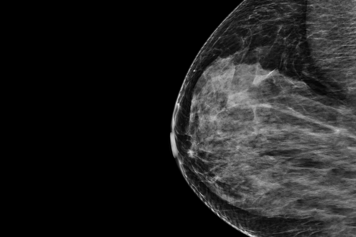 ai-based-breast-cancer-risk-technology-receives-fda-breakthrough-device-designation
