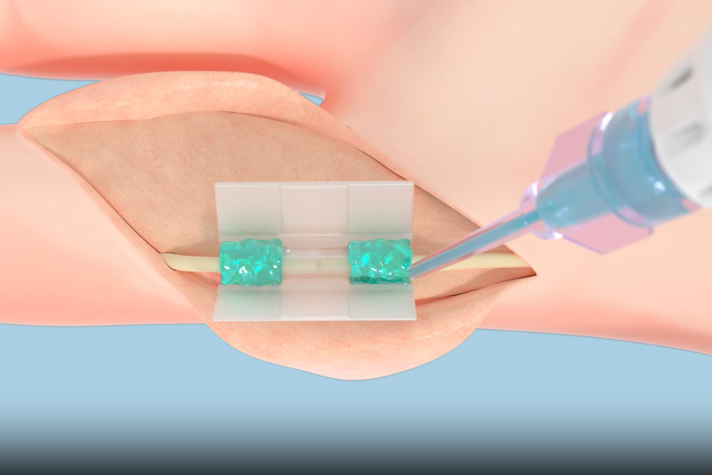 Revolutionizing Healing: The Future of Suture-Free Tissue Reconstruction