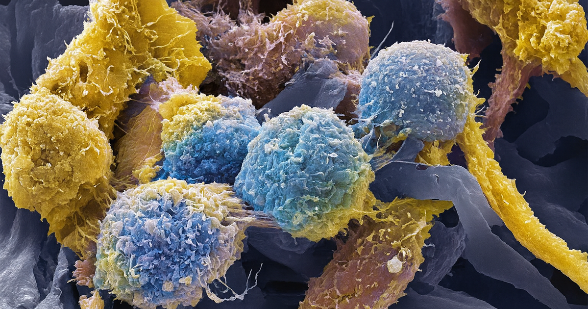 Ask the expert: How to prevent cervical cancer
