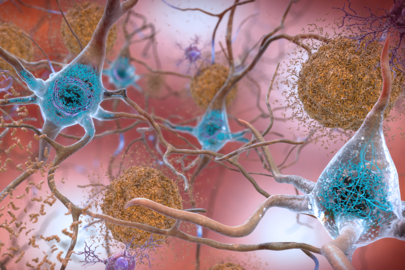 Unraveling Alzheimer’s: The Role of a Unique Gene Variant in Disease Development
