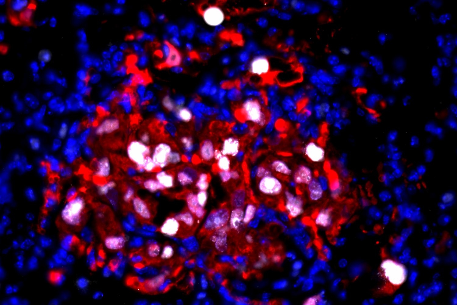 “Inflammation Awakens Dormant Cancer Cells, Sparking a Return to Growth”