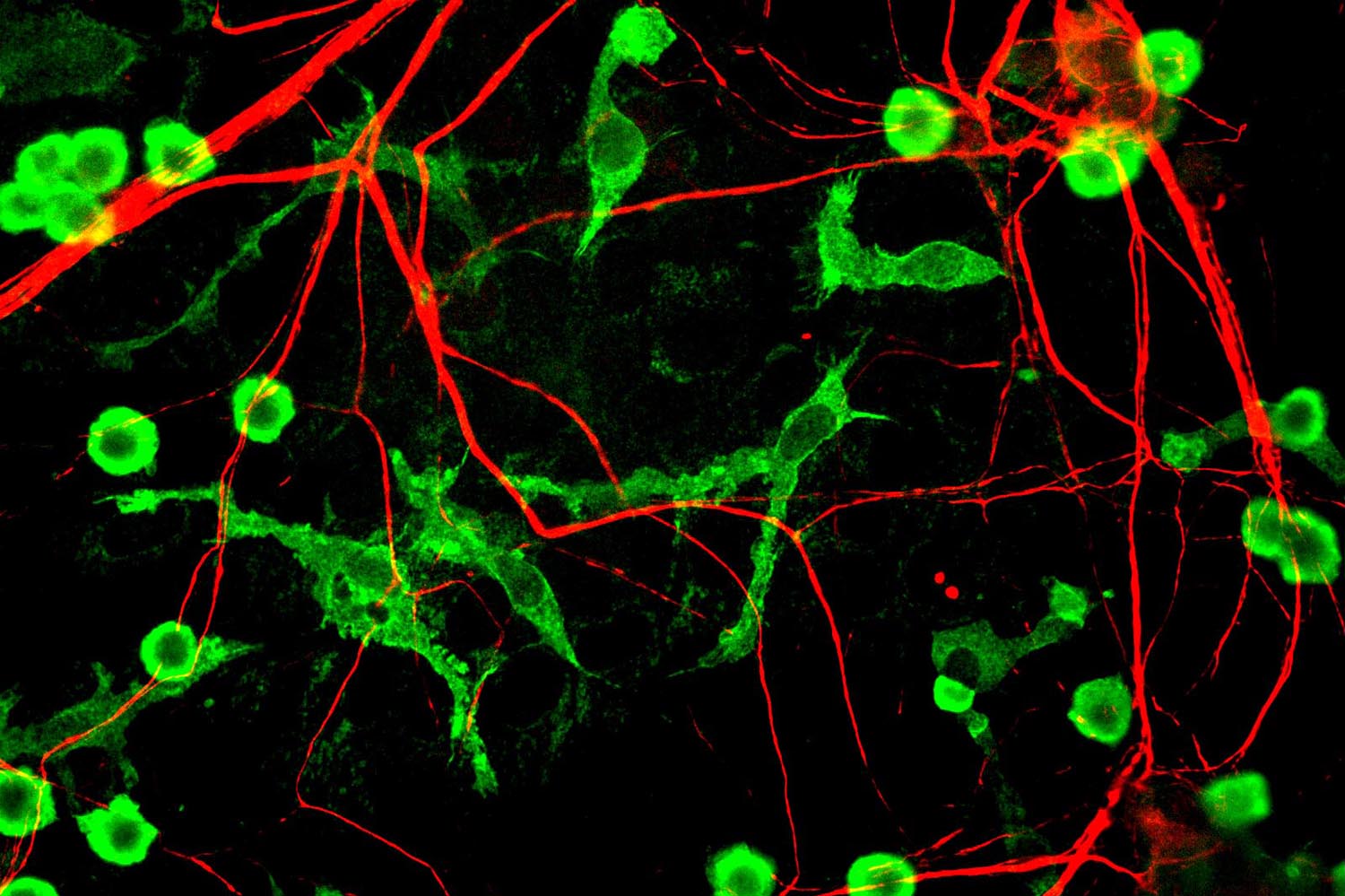 Reimagining Alzheimer’s: Uncovering the Hidden Impact of Lipid Microvesicles