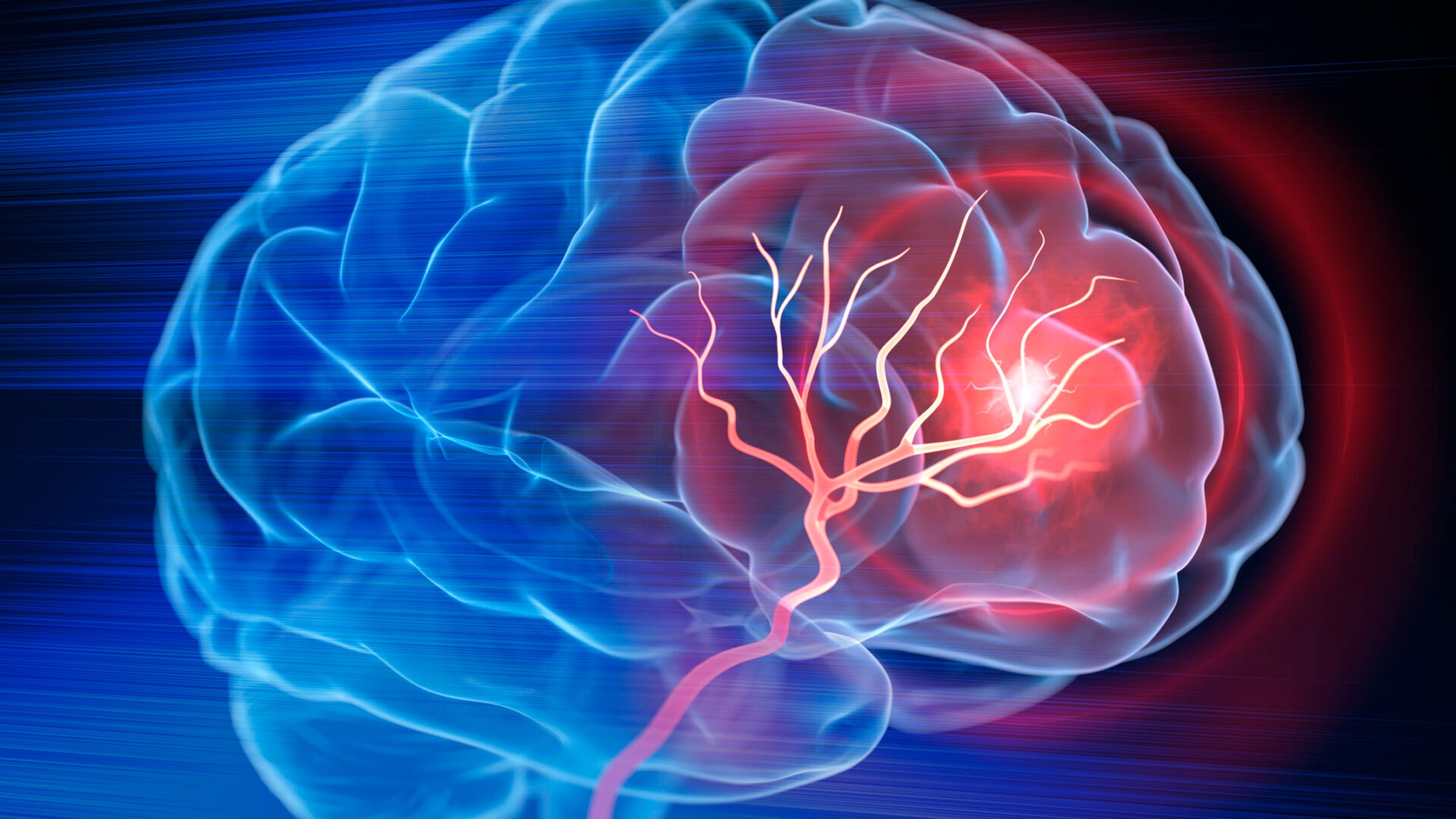 Stem Cell Transplant After Stroke Promotes Brain Healing and Recovery, Study Shows